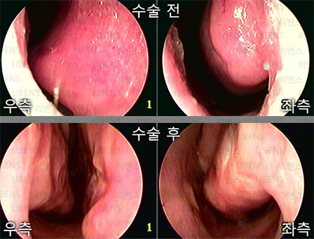 비중격만곡증 수술 비중격 교정술 성형술 비염수술 하비갑개 점막하절제술 전후사진 6