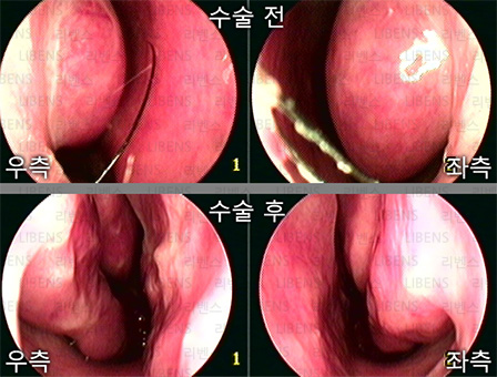 비중격만곡증 수술 비중격 교정술 성형술 비염수술 하비갑개 점막하절제술 전후사진 2