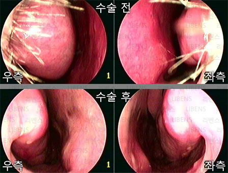 비중격만곡증 수술 비중격 교정술 성형술 비염수술 하비갑개 점막하절제술 전후사진 4