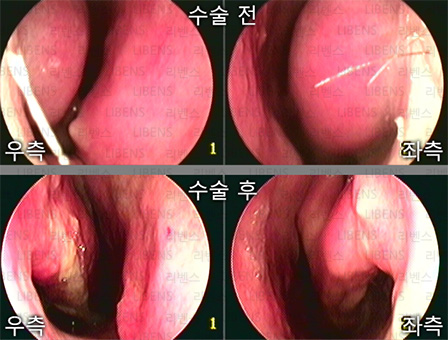 비중격만곡증 수술 비중격 교정술 성형술 비염수술 하비갑개 점막하절제술 전후사진 3