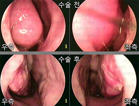 비중격만곡증 수술 비중격 교정술 성형술 비염수술 하비갑개 점막하절제술 전후사진 1
