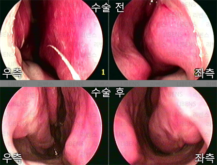 비중격만곡증 수술 비중격 교정술 성형술 비염수술 하비갑개 점막하절제술 전후사진 8