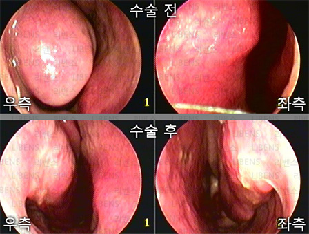 비중격만곡증 수술 비중격 교정술 성형술 비염수술 하비갑개 점막하절제술 전후사진 10