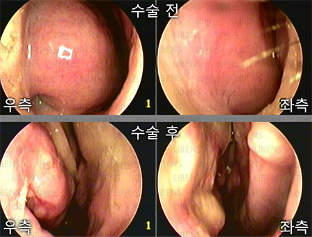 비중격만곡증 수술 비중격 교정술 성형술 비염수술 하비갑개 점막하절제술 전후사진 5