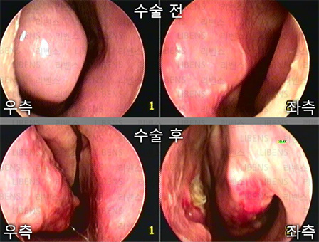비중격만곡증 수술 비중격 교정술 성형술 비염수술 하비갑개 점막하절제술 전후사진 9