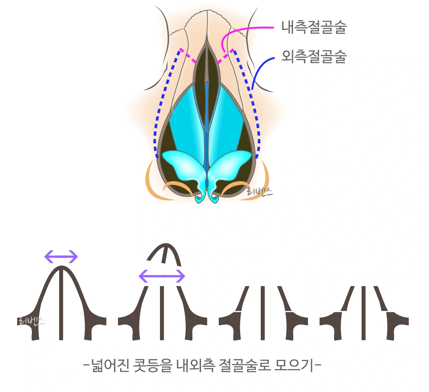 매부리코 코뼈 내측 외측 내외측 절골
