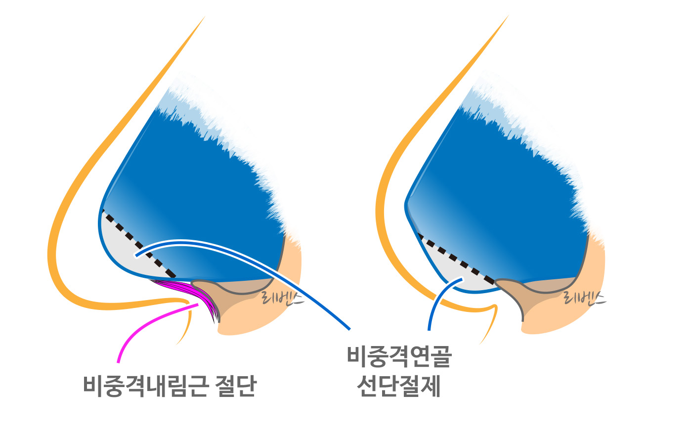 치진 코끝 성형 수술 화살코 : 비중격 선단절제, 내림근 절단 자르기