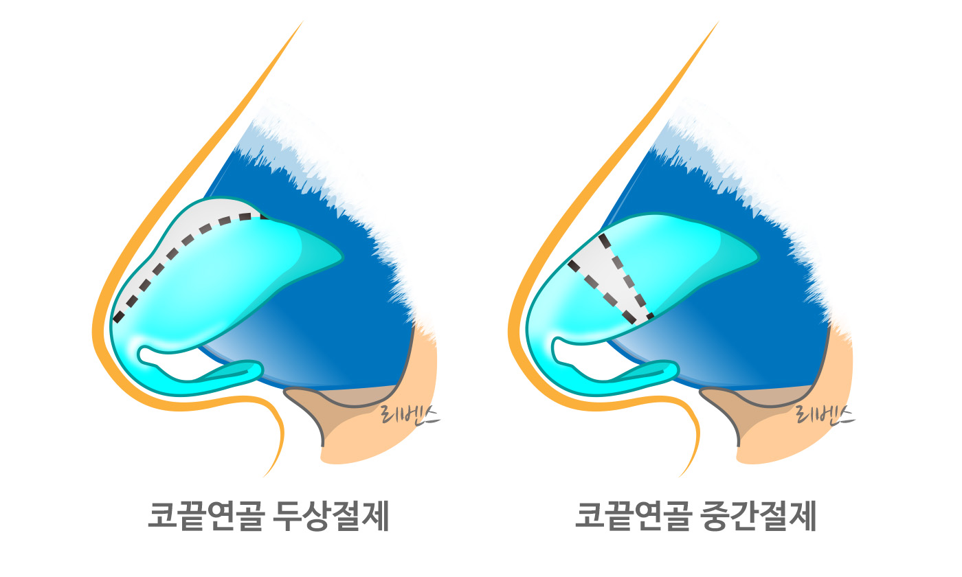 치진 코끝 성형 화살코 수술 코끝연골 두상절제, 중간절제