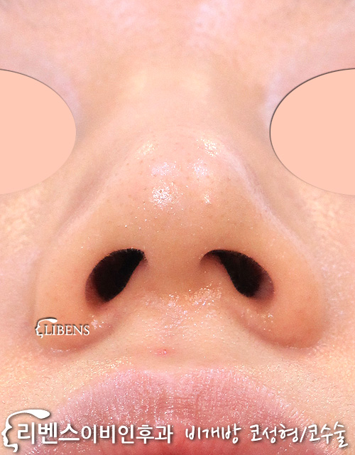 무보형물 매부리코 메부리코 수술 제거 깍기 코끝 높이기 비중격만곡증 성형 s1093