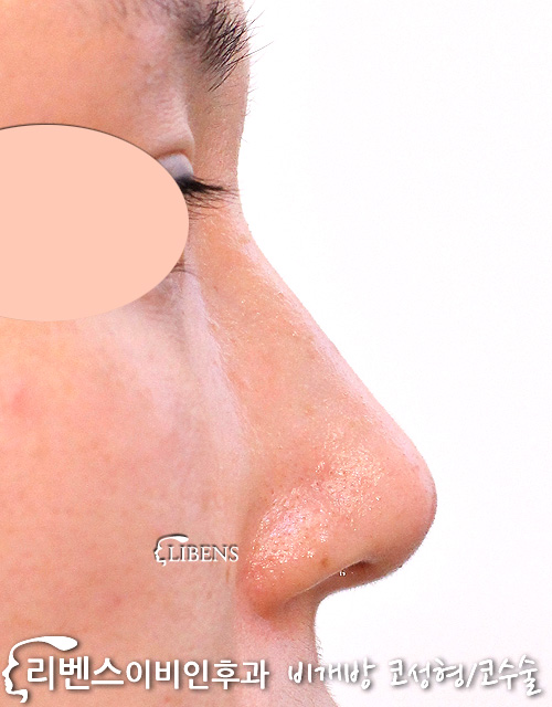 매부리코성형 메부리코 수술 비중격코성형 교정 코끝 높이기 무보형물 여자 연골 묶기 성형 s1161