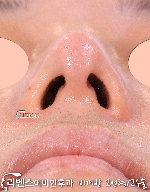 매부리코성형 메부리코 수술 비중격코성형 교정 코끝 높이기 무보형물 여자 연골 묶기 성형 s1161