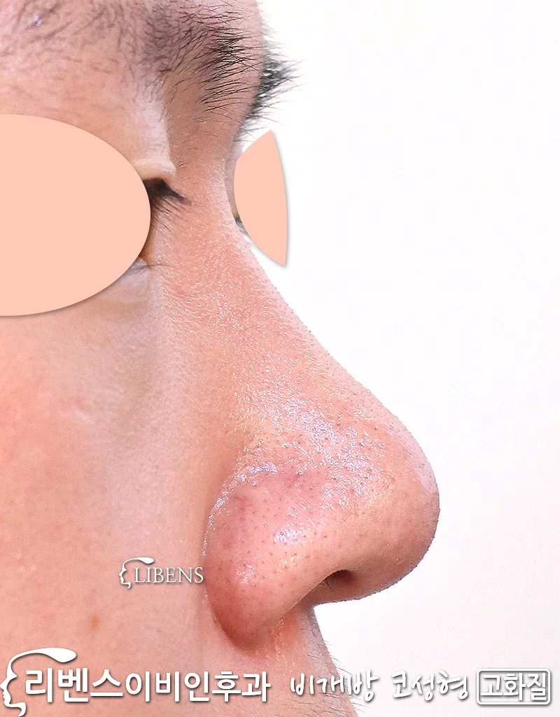 콧대 성형 수술, 남자 남성. 실리콘 3미리, 코끝성형, 7개월째 성형 s1197