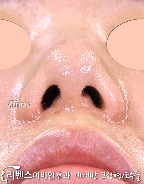 매부리코 교정 성형 휜코수술 코끝성형 내외측 절골 코끝 연골묶기 성형 s786