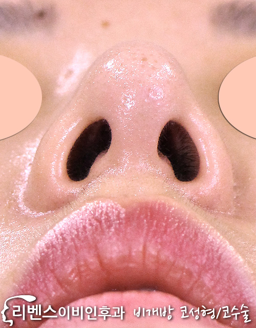 매부리코 메부리코 휜코 성형 수술 교정 복코 무보형물 코끝 연골재배치 성형 s815