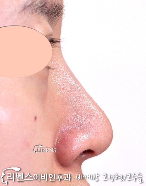 코끝성형 코끝수술 메부리코교정 코끝연골재배치 매부리갈기 매부리코성형 성형 s837