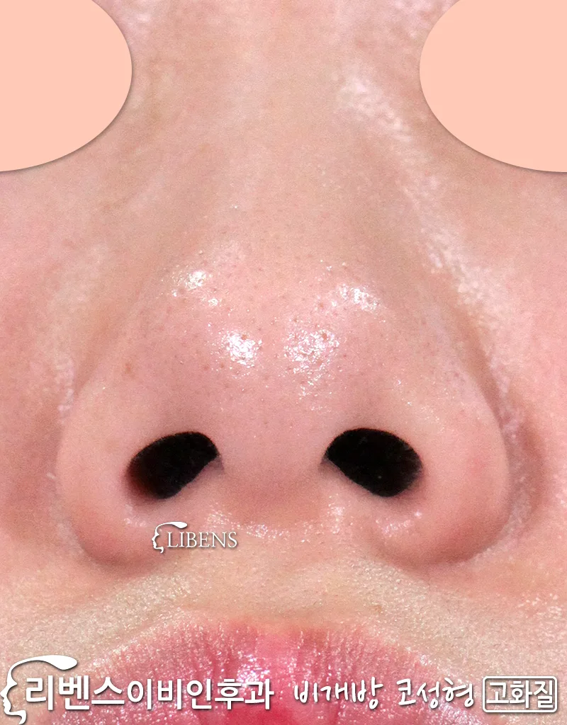 [비개방 코성형] 콧등 실리콘 삽입.<br>낮은 콧등, 매부리코, 넓은 코끝, 낮은 코끝, 여자