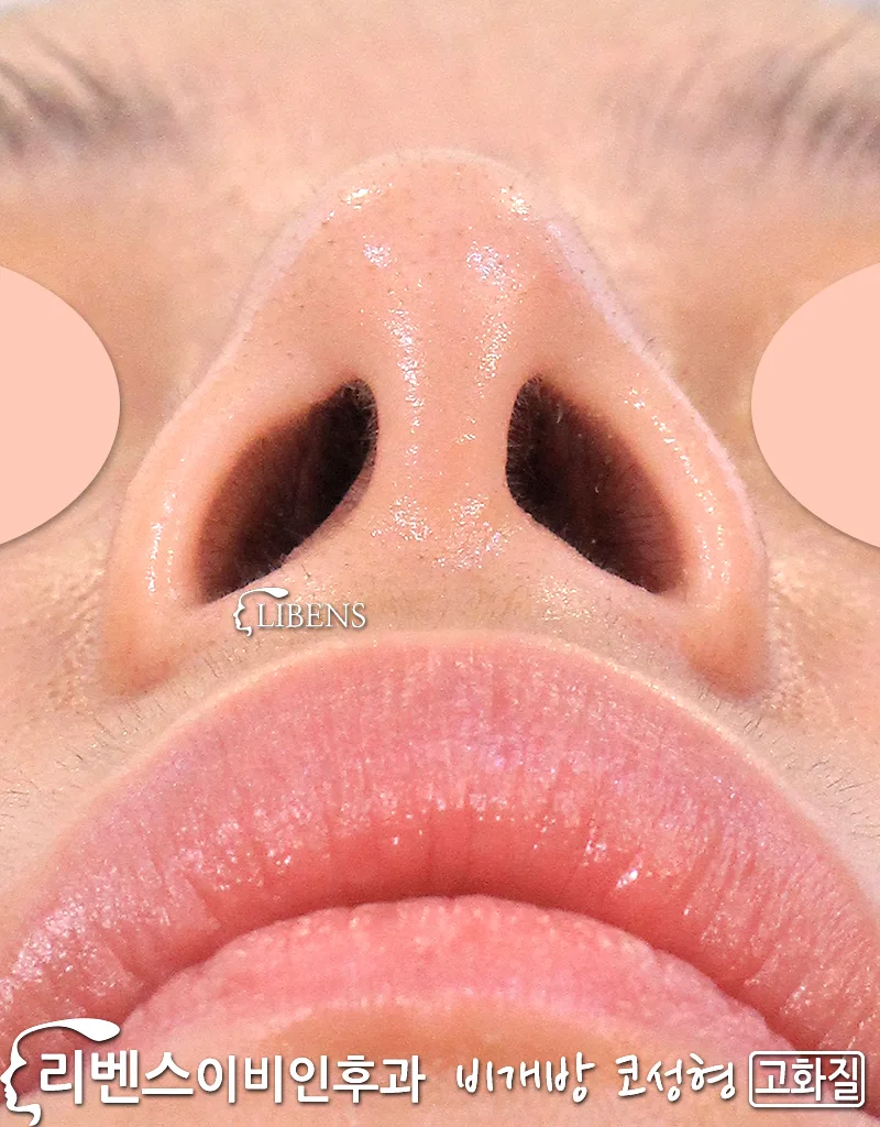 여자 무보형물 매부리코 성형 깍기, 휜코 코끝 수술 비염 비중격만곡증  성형 s1169