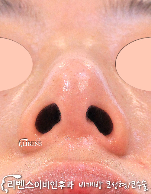 비개방 무보형물 매부리코 메부리코 성형 제거 수술, 비대칭 콧구멍 교정, 코끝 높이기. 여자 성형 s1171