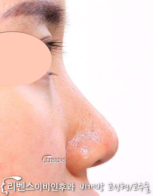 무보형물 여자, 낮은 코끝 성형 복코 수술 교정. 코뼈 갈기, 두꺼운 두터운 코 피부. 성형 s1179