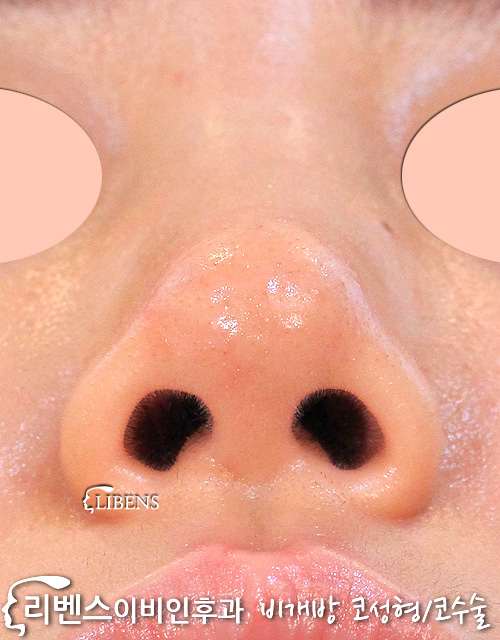 무보형물 여자, 낮은 코끝 성형 복코 수술 교정. 코뼈 갈기, 두꺼운 두터운 코 피부. 성형 s1179