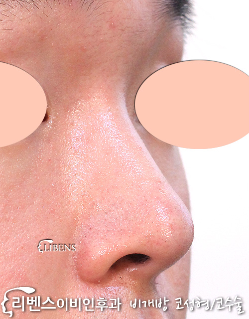 코끝성형 남자 무보형물 코끝수술 복코성형 복코수술 코끝모으기 성형 s1182