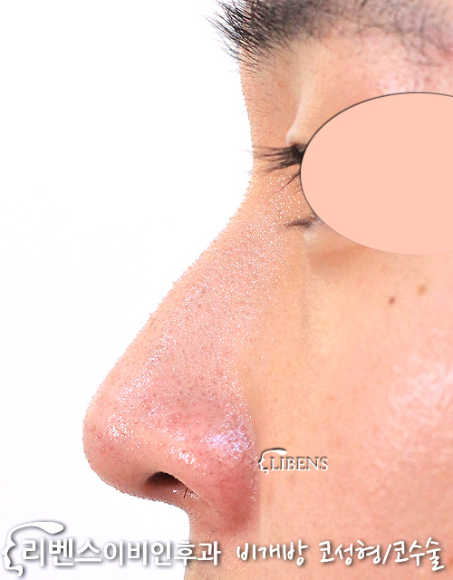 무보형물 매부리코성형, 남자 코끝성형 비중격만곡증 비염 수술  성형 s1186