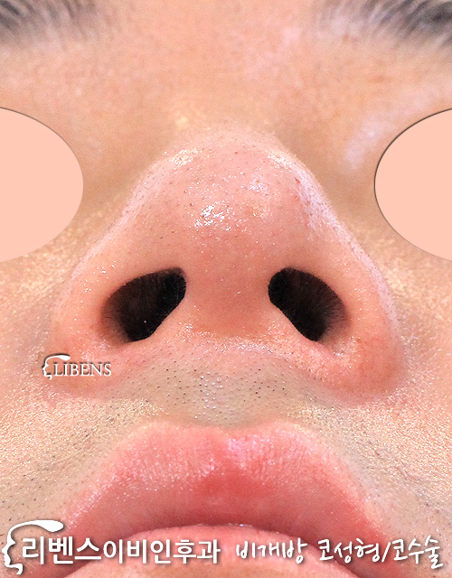 무보형물 매부리코성형, 남자 코끝성형 비중격만곡증 비염 수술  성형 s1186