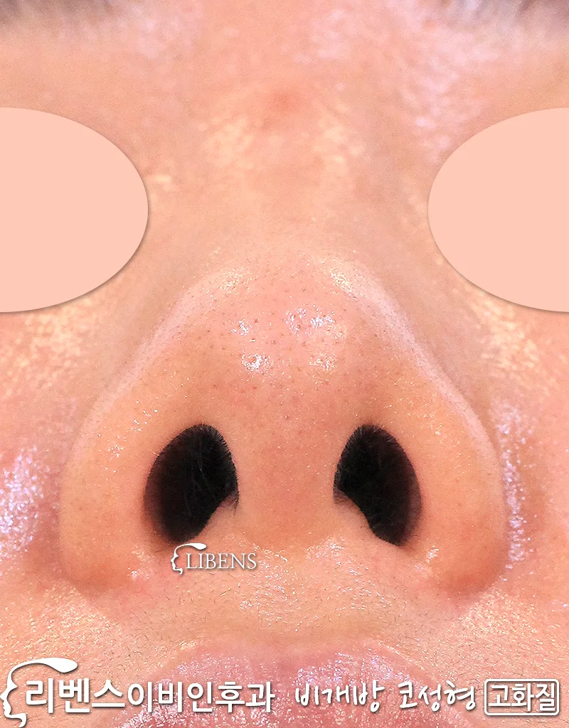 코끝성형 코끝수술 복코성형 복코수술 코끝연골재배치 코끝연골묶기 여자 성형 s1195