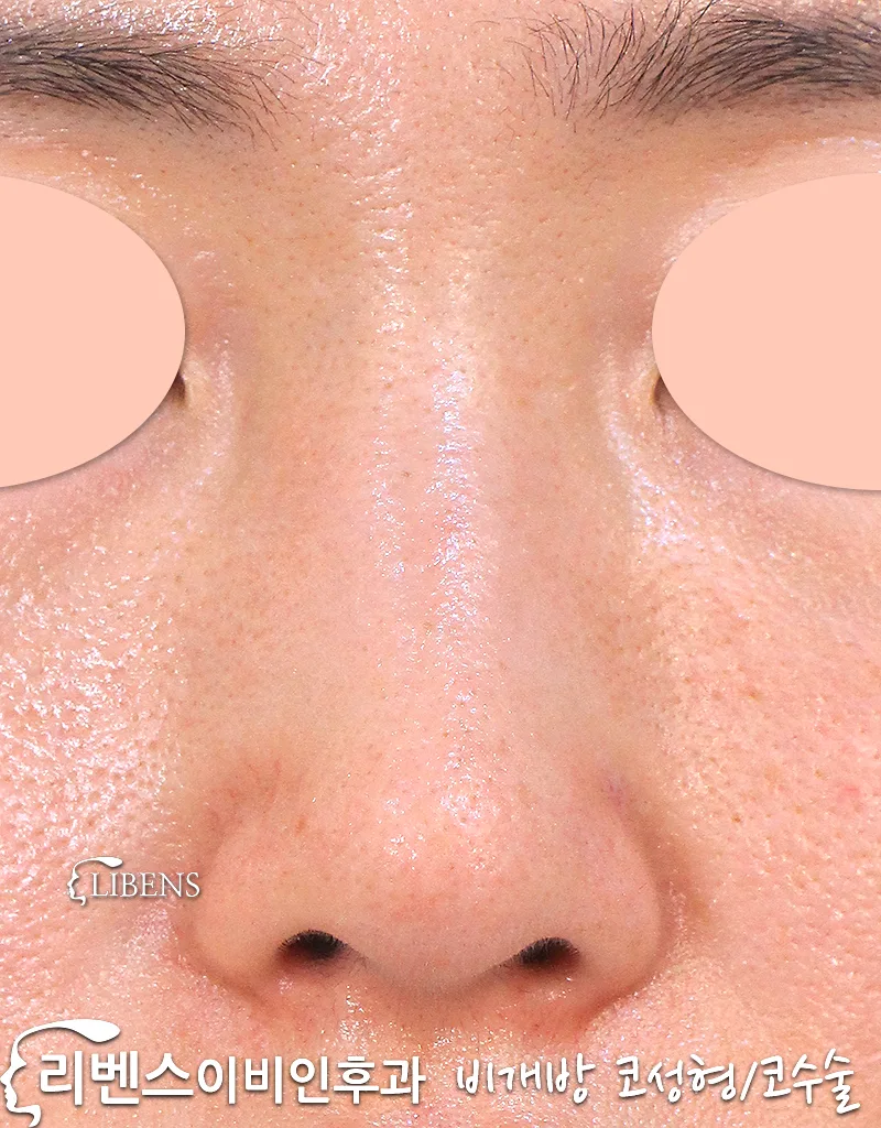 여자 매부리코 성형 수술, 휜 코 교정, 코끝 성형 수술. 무보형물, 콧대 코뼈 내측 외측 절골. 성형 s1212