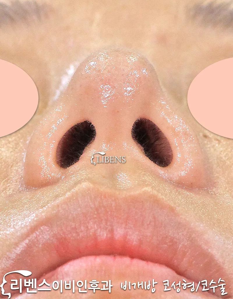 매부리코 메부리코 수술 휜코 교정 무보형물 코끝 비중격 연골 높이기 묶기 성형 s1028