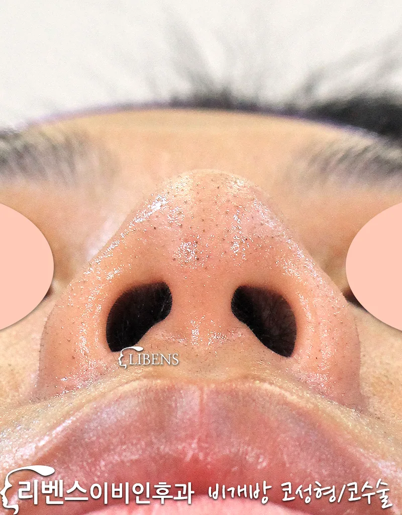 코끝만 성형 수술 비중격 연골 삽입 남자 무보형물 콧구멍 교정 비주 늘이기 성형 s1047