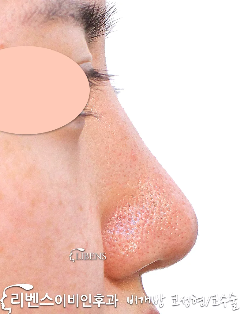 무보형물 비개방 매부리코 메부리코 수술 코절골 두꺼운 피부 코끝 복코 성형 s1065