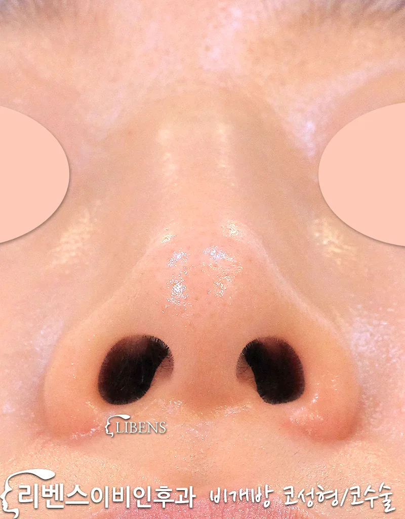 무보형물 휜코 매부리코성형 매부리깍기 코끝 수술 높이기 코절골 성형 s1084