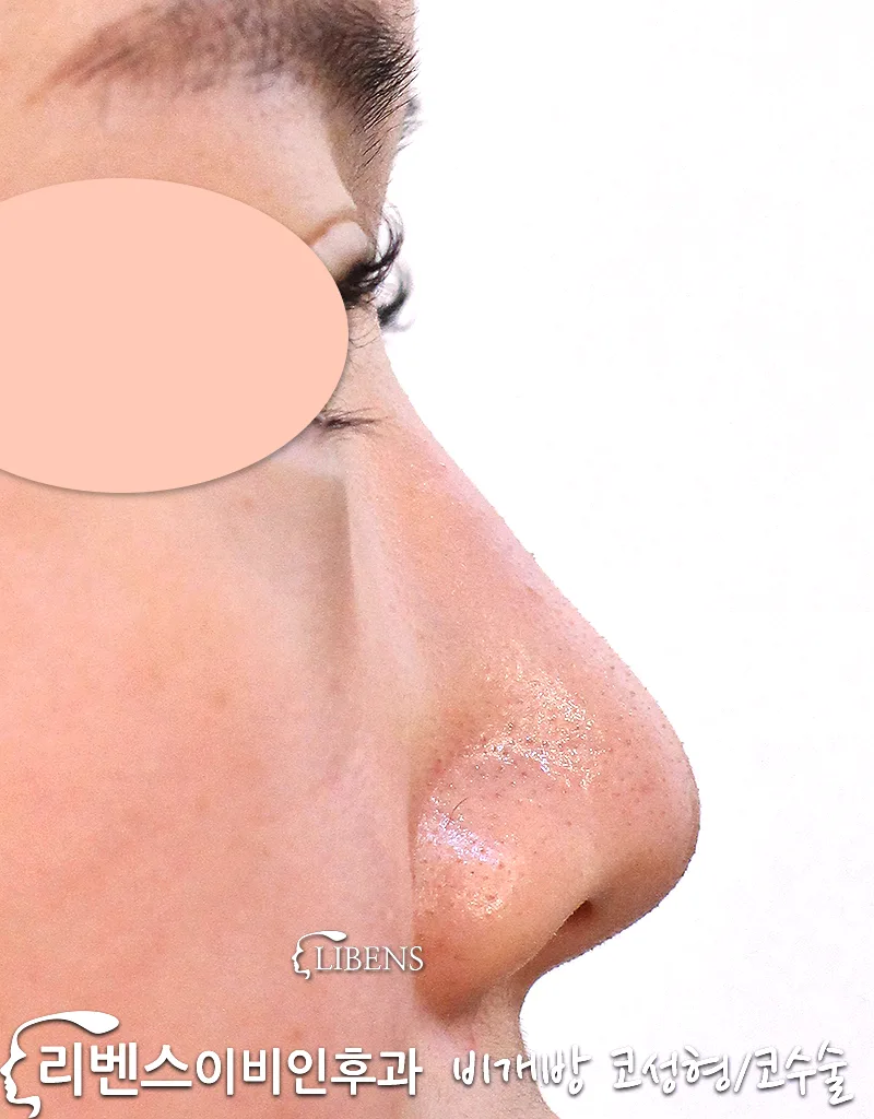 여자 코끝 수술만, 낮은 코끝, 복코, 들창코, 비중격연골 삽입, 코끝 연골묶기 재배치 성형 s1089