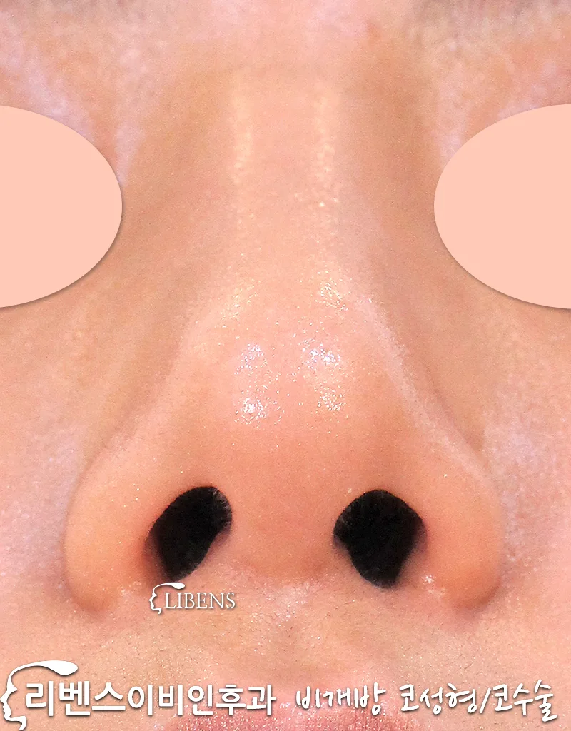 실리콘 3미리 콧대 성형 콧등 높이기 들창코 코끝 수술. 비염수술 성형 s1102