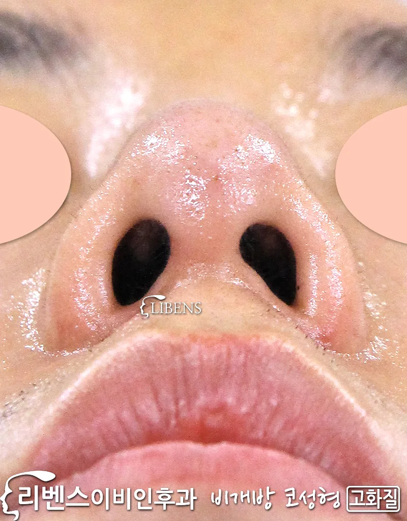 무보형물 매부리코 메부리코 코끝 복코 성형 수술 비중격 만곡증 성형 s738