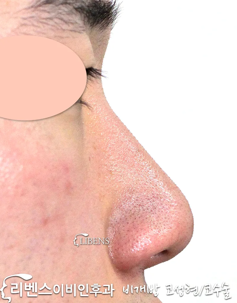 남자 복코 콧날개 콧구멍 교정 매부리코 수술 갈기 코끝 비염 수술 성형 s787