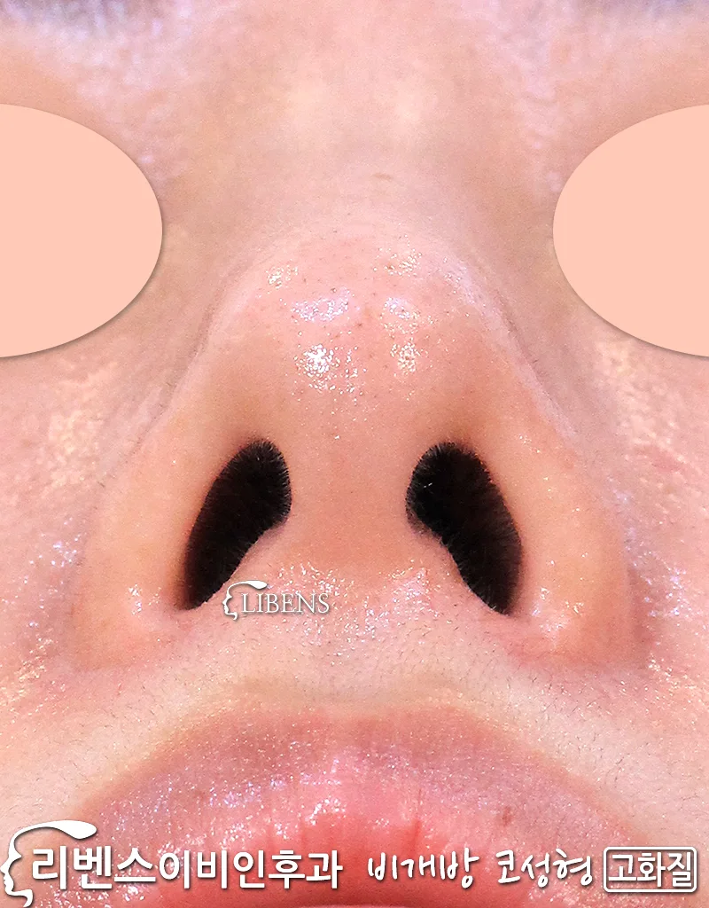 무보형물 메부리코 매부리코 휜코 낮은 코끝 성형 수술 높이기 비중격만곡증 성형 s1142