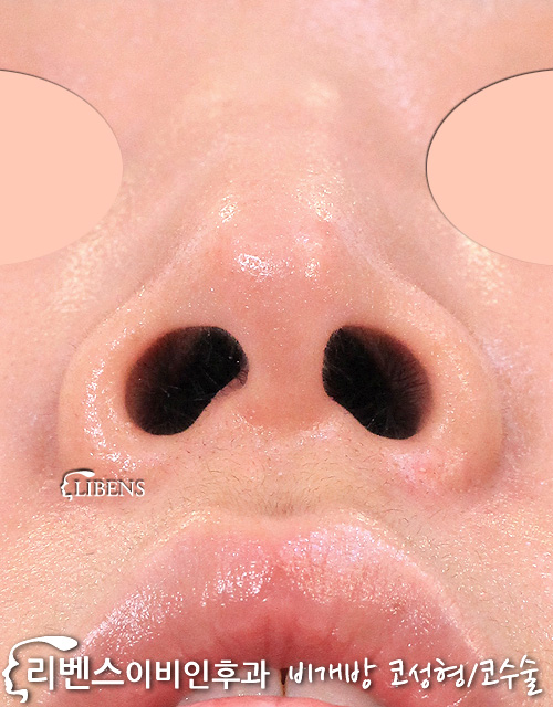 매부리코성형 메부리코 퍼진 비대칭 콧구멍 수술 교정 낮은 코끝 높이기 비중격 연골 성형 s1143