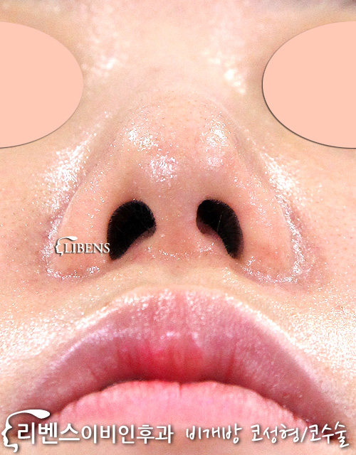무보형물 코성형 매부리코 메부리코 낮은 코끝 복코 수술 성형 성형 s792