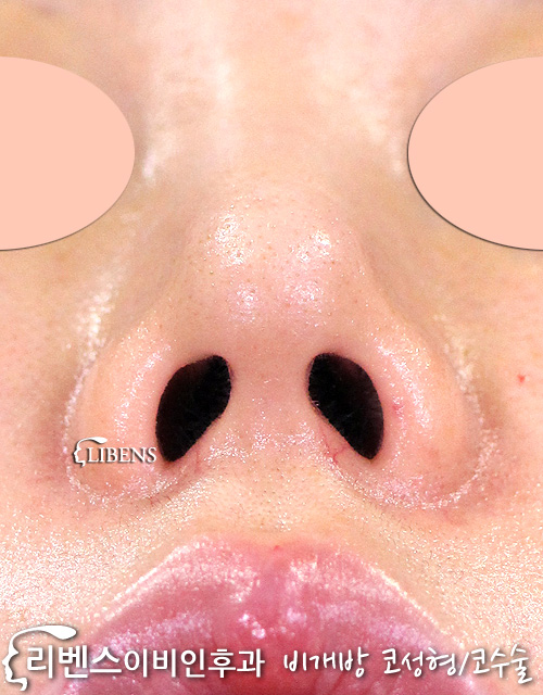 에버코 제거 콧등 콧대 높이기 성형 수술 실리콘 2미리 비염 코막힘 성형 s820