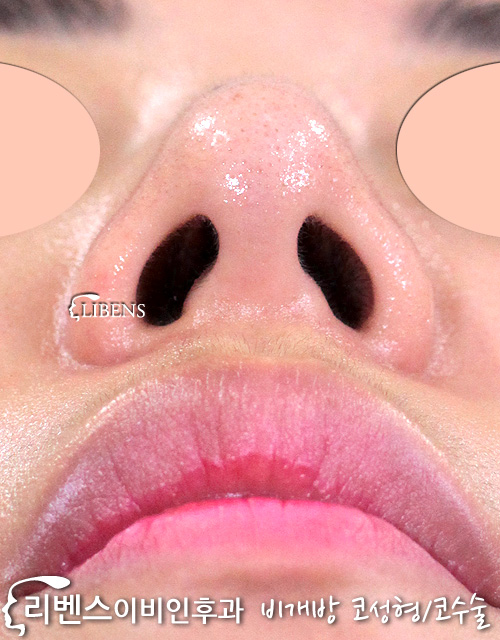 여자 매부리코성형 코끝성형 코끝연골재배치 성형 s854