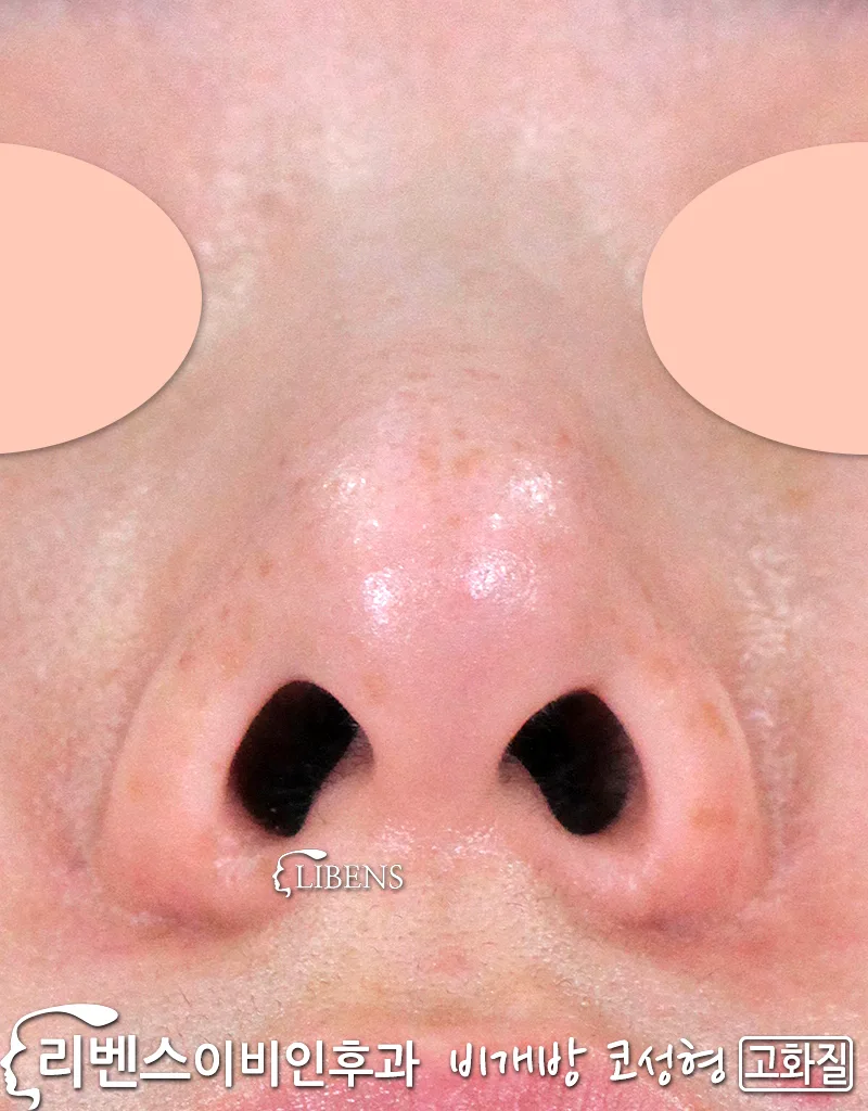 매부리코 메부리코, 처진 낮은 넓은, 코끝 수술 성형 교정 무보형물 성형 s913