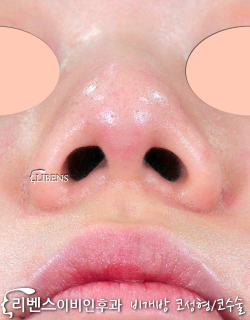 무보형물 매부리 메부리 코수술 코끝 콧구멍 교정 성형 여자 성형 s917