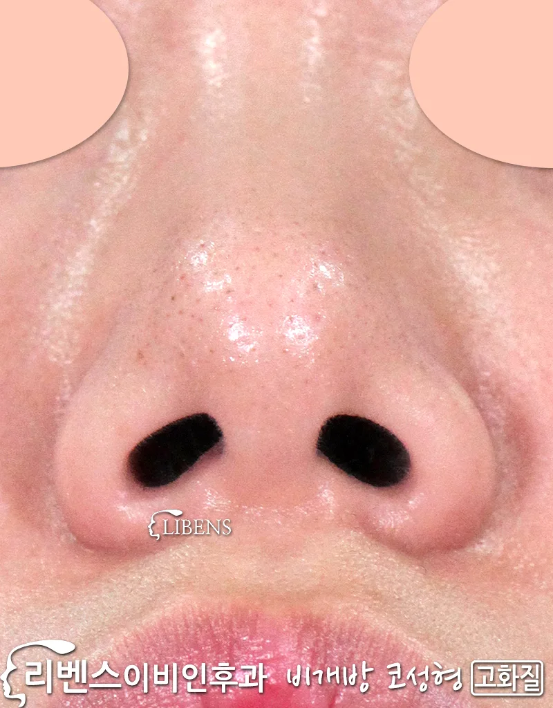 [비개방 코성형] 콧등 실리콘 삽입.<br>낮은 콧등, 매부리코, 넓은 코끝, 낮은 코끝, 여자