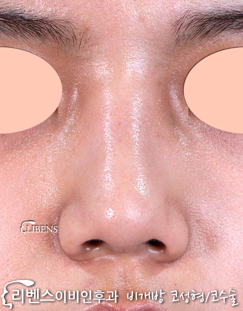 매부리코 메부리코 수술 성형 여자 코끝 높이기 무보형물 성형 s937