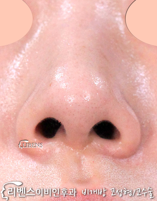 무보형물 매부리코 메부리코 교정 성형 수술 비중격연골 코끝 복코 축소 성형 s957