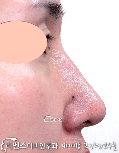 여자 무보형물 매부리코 메부리코 수술 교정 성형 처진 코끝 성형 s972