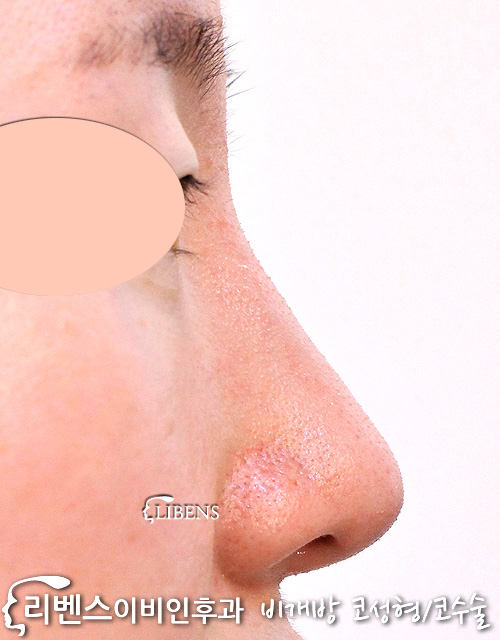 여자 매부리코성형 메부리코 비중격 수술 코뼈 휜코 절골 넓은 코끝 복코 무보형물 성형 s1131