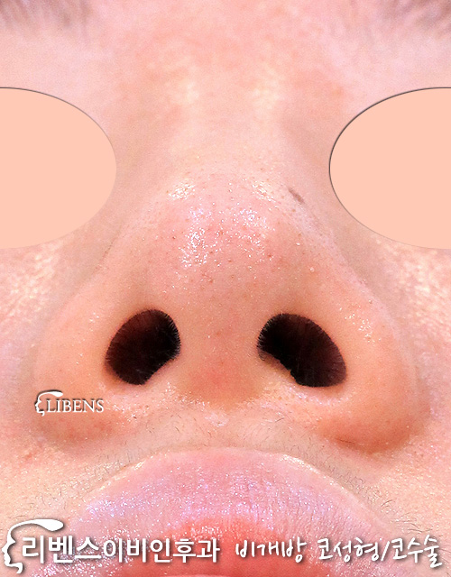 여자 매부리코성형 메부리코 비중격 수술 코뼈 휜코 절골 넓은 코끝 복코 무보형물 성형 s1131